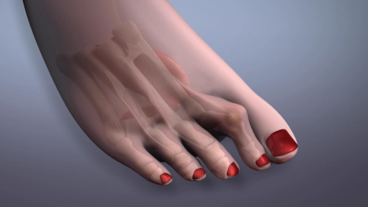 Could Hammer Toe Result In Plantar Fasciitis Ivelisse Harnar