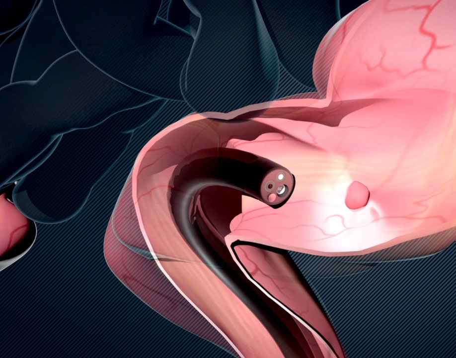 Medical Animation from Visual Health Solutions